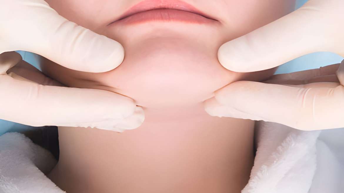 Kybella