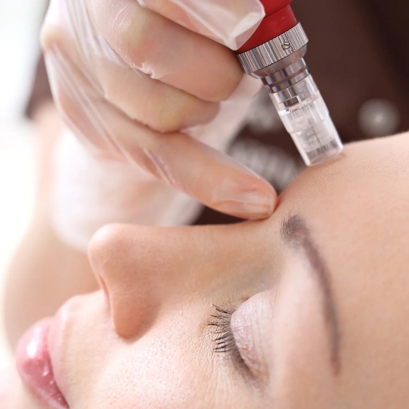 Hyaluronic Acid - Microneedling