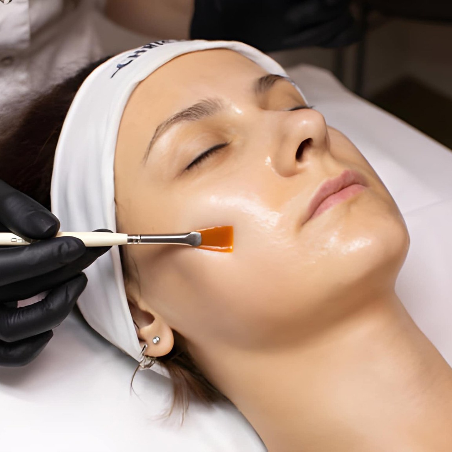 Perfect Derma Peel Treatment Seattle, WA